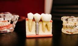 Why Root Canal Treatment Works and Shouldn’t Be Feared